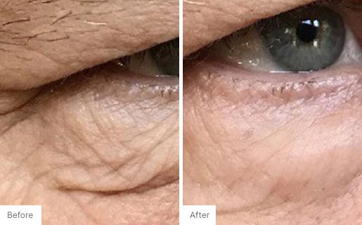 6 - Before and After Real Results photo of a woman's eye area.