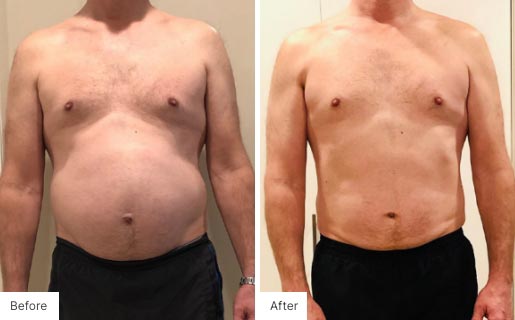 2 - Before and After of a man's body using NeoraFit.