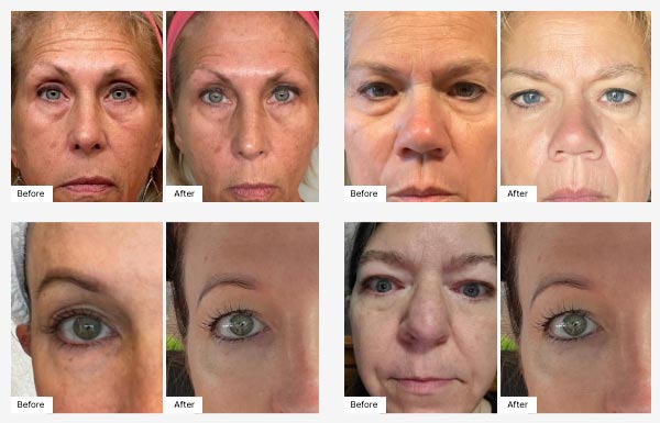 Before and After RealResult photos of people that have used the Glow Getter Gift Set.